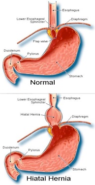 Hernie hiatale et reflux