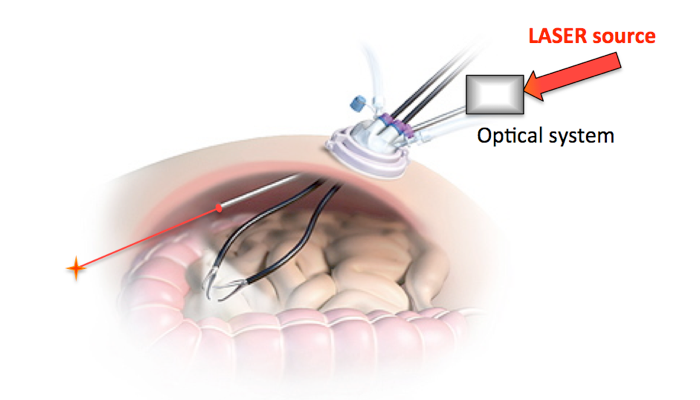 LASER et chirurgie de la vésicule biliaire par laparoscopie à ...