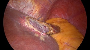 Les Kystes biliaires (Simple Hepatic Cyst)