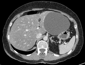 Les Kystes biliaires (Simple Hepatic Cyst)