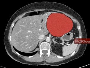 Les Kystes biliaires (Simple Hepatic Cyst)