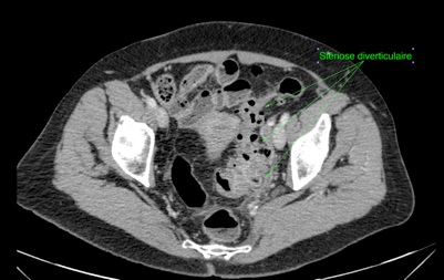 Les Sténoses Sigmoïdiennes Diverticulaires: une forme de la ...