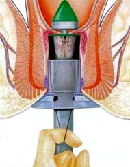 Hémorroïdes internes — Wikimedica